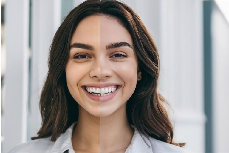botox before and after